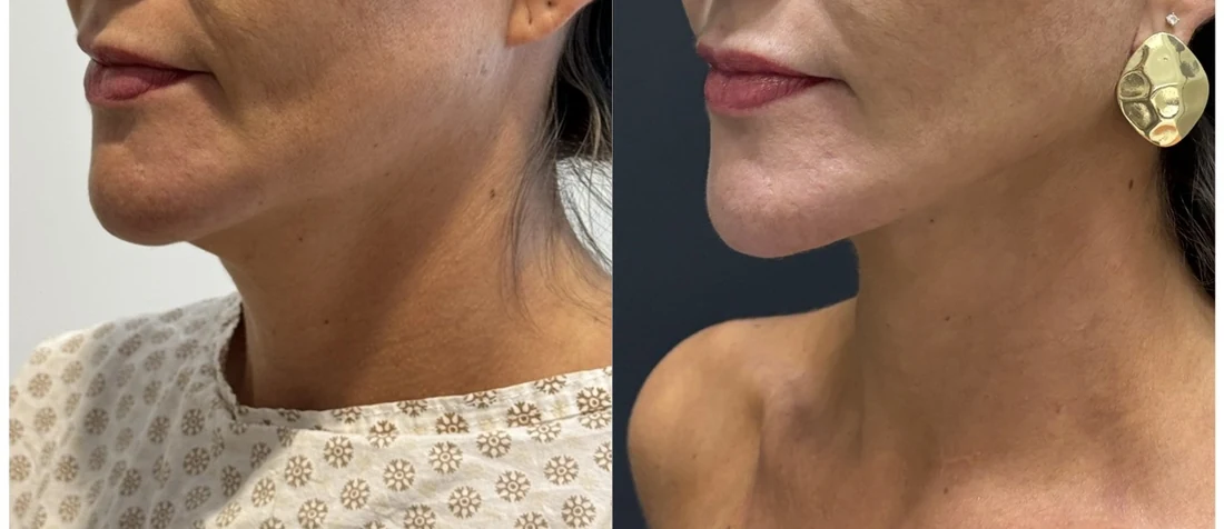 Comparação de perfil do contorno cervical antes e depois do tratamento profundo de face e pescoço