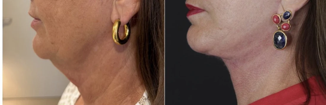 Comparação de perfil da linha da mandíbula antes e depois do tratamento
