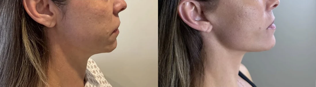 Comparação do ângulo cervical antes e depois, lado a lado